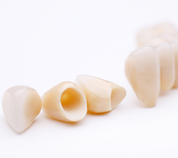 Reston Dental Crowns and Dental Bridges