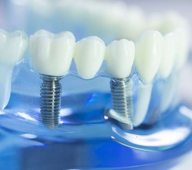 Reston Dental Implants
