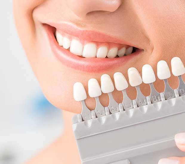 Reston Dental Veneers and Dental Laminates